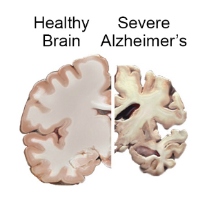 brain_slices_alzheimers_0.jpg